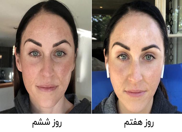 میکرونیدلینگ، روزهای ششم و هفتم