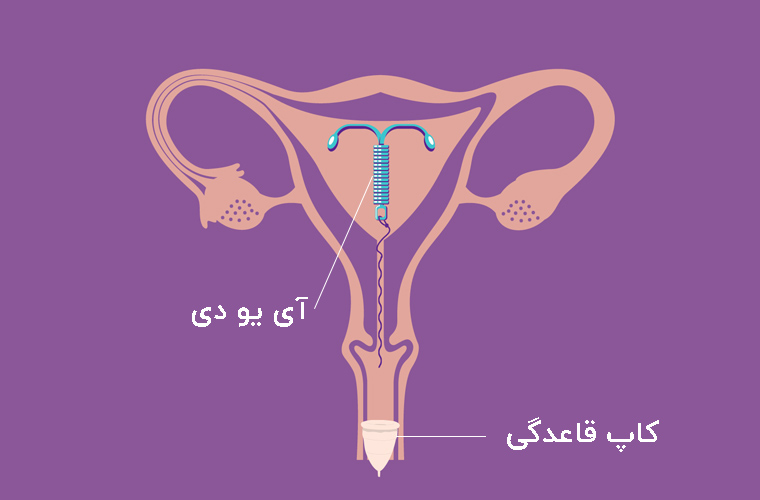 کاپ قاعدگی - محل قرارگیری کاپ و آی یو دی